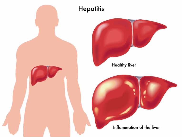 Hepatitis A baby